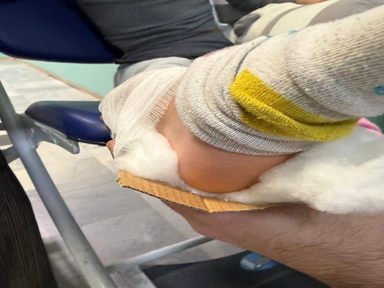 Родители сигнализираха за необичайно обездвижване на счупен крак в Спешния център в Разлог